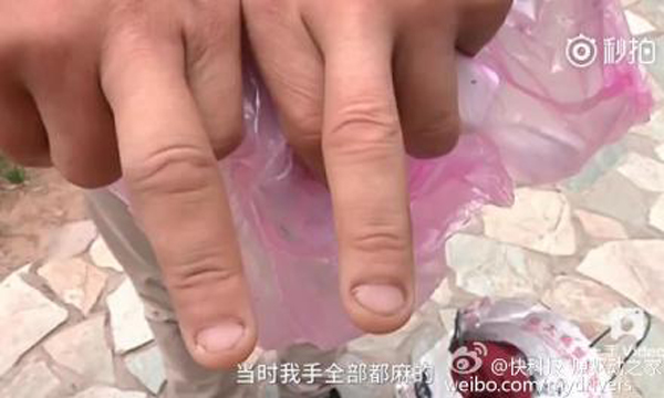 男子手部和臉部不同程度被炸傷。 男子手部和臉部不同程度被炸傷。